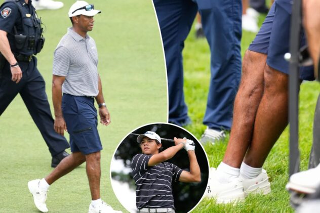 Tiger Woods exposes gnarly leg ruined by injuries from horrific car crash